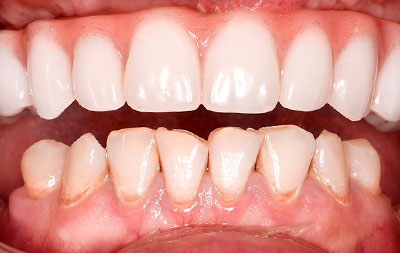 Фото после установки зубных имплантов Pro Arch от Straumann