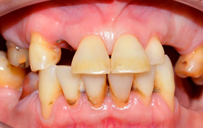 Генерализованный пародонтит, разрушение, подвижность и выпадение оставшихся зубов