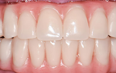 фото имплантация и протезирование зубов