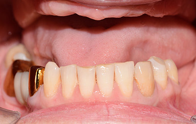 Полное отсутствие зубов на верхней челюсти