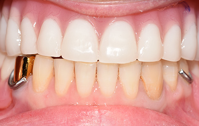 Проведена комплексная имплантация зубов