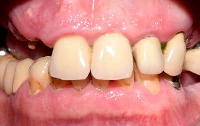 фото зубов до имплантации