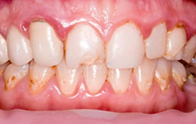 Фото зубов до установки керамических виниров на зубы
