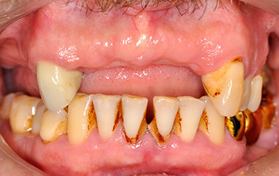 На верхней челюсти осталось 4 зуба