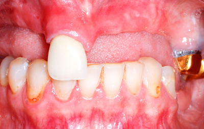 Почти полное отсутствие собственных зубов на верхней челюсти