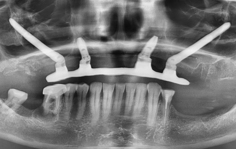 Снимок Удаление собственных зубов, установка имплантов