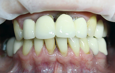 Подвижность части жевательных зубов