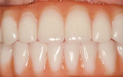 Удаление пораженных зубов и одномоментная установка имплантов 