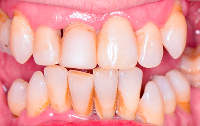 Подвижность зубов, деформация прикуса