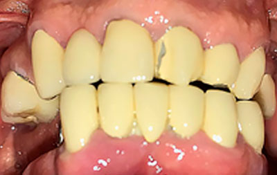 Ситуация до имплантации зубов