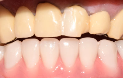 Имплантация зубов на нижней челюсти