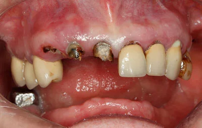 Фото состояния зубов до проведения комплексной имплантации зубов