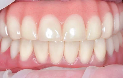 Фото после комплексной имплантации зубов на нижней челюсти