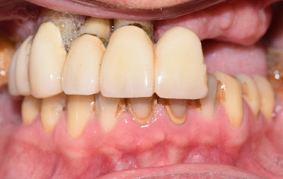 Частичная адентия и разрушение зубов