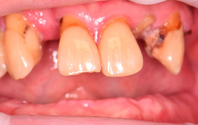 До имплантации - множественное отсутствие зубов