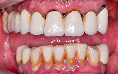 Разрушение мостовидных протезов и живых зубов под ними