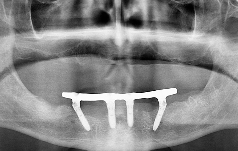 Снимок На верхней челюсти установлен съемный акриловый протез, на нижней имплантация по протоколу All-on-4