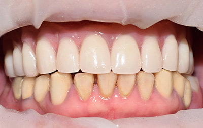 На верхней челюсти все зубы восстановлены по технологии базальной имплантации