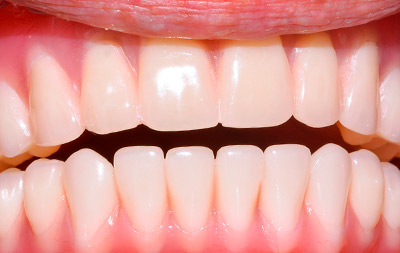 Фото после имплантации зубов на 4 имплантах