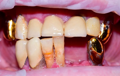 Отсутствие и подвижность зубов