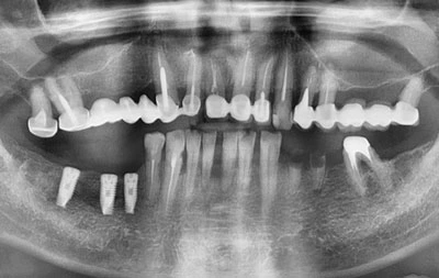 Снимок до проведения имплантации зубов