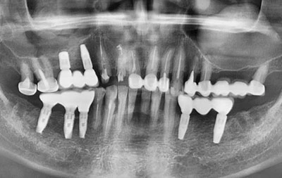 Снимок зубов после установки имплантов жевательных зубов