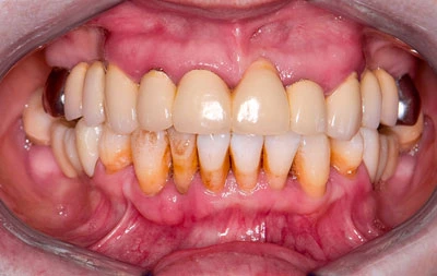 Фото с проблемами зубов до имплантации: изношенность коронок и мостовидных конструкций, пародонтит и подвижность зубов