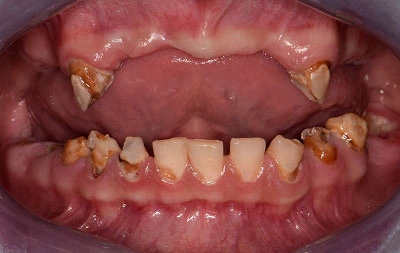 Фото состояния зубов до проведения полной имплантации зубов