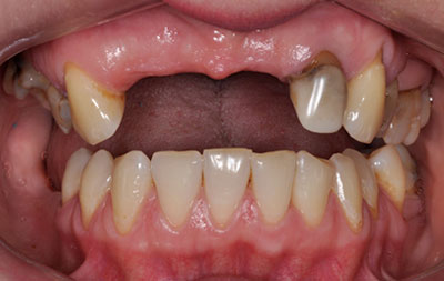 Частичное отсутствие зубов верхней челюсти