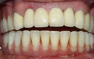 Фото после восстановления зубов по имплантации зубов