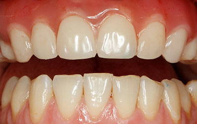 Удаление оставшихся зубов с одновременной установкой 4 имплантов Nobel Biocare по протоколу all-on-4