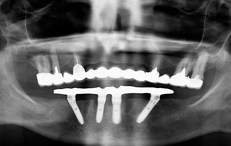 Снимок установка имплантов Nobel Biocare на нижней челюсти по технологии All-on-4