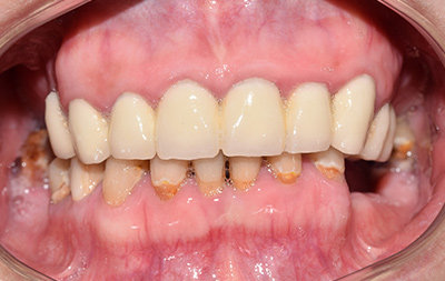 Отсутствие жевательных зубов