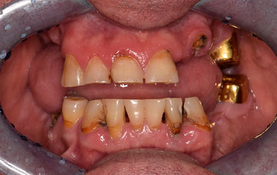 Фото до комплексной имплантации зубов Straumann