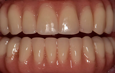 Фото сразу после комплексной имплантации зубов Straumann