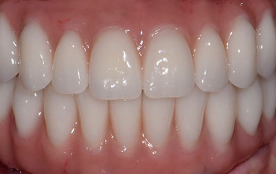 Фото после перепротезирования зубов на имплантах