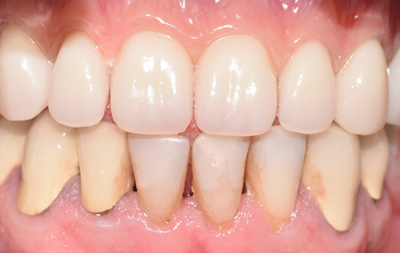Восстановление всех зубов на верхней челюсти 