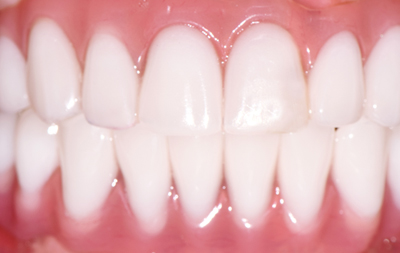 восстановление зубов на двух челюстях по протоколу all-on-6