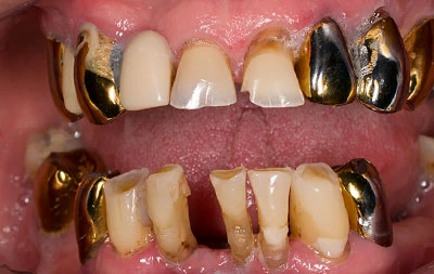 Фото состояния зубов пациента до имплантации зубов
