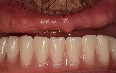 Как выглядели зубы пациента до скуловой имплантации - фото