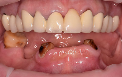 Фото до проведения имплантации зубов