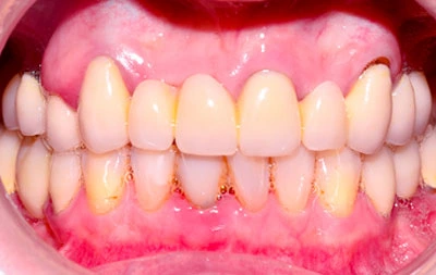 Фото зубов пациентки до проведения операции по имплантации
