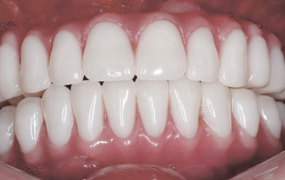  имплантация зубов на верхней и нижней челюсти по оригинальной технологии All-on-4