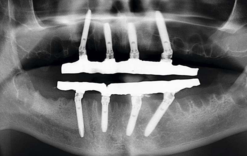 Снимок  имплантация зубов на верхней и нижней челюсти по оригинальной технологии All-on-4