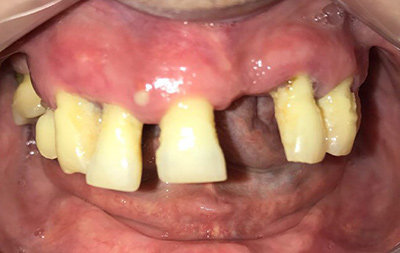 отсутствие зубов на нижней челюсти и на верхней – находятся на грани выпадения