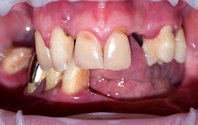  пародонтит, подвижность и выпадение зубов