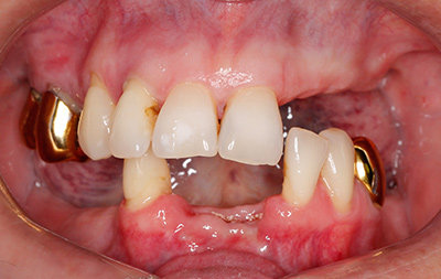 Почти полное отсутствие зубов на верхней и нижней челюстях