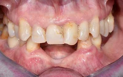 Фото состояния зубов пациентки до установки зубных имплантов
