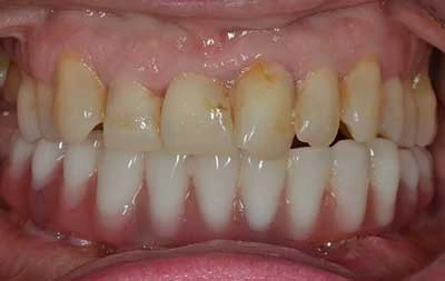 Фото зубов после имплантации зубов и установки адаптационных протезов