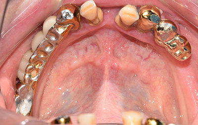 Почти полное разрушение зубов на нижней челюсти